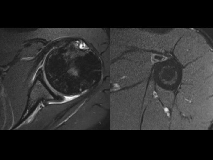 Figure 1 for case tendon of long head of biceps brachii ( RID1944 )